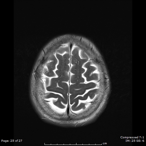 File:Anterior temporal lobe perivascular space (Radiopaedia 88283-104914 Axial T2 25).jpg