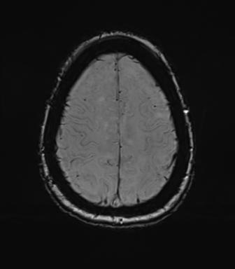 Anterior temporal pole cysts (Radiopaedia 46629-51102 Axial SWI 71).png