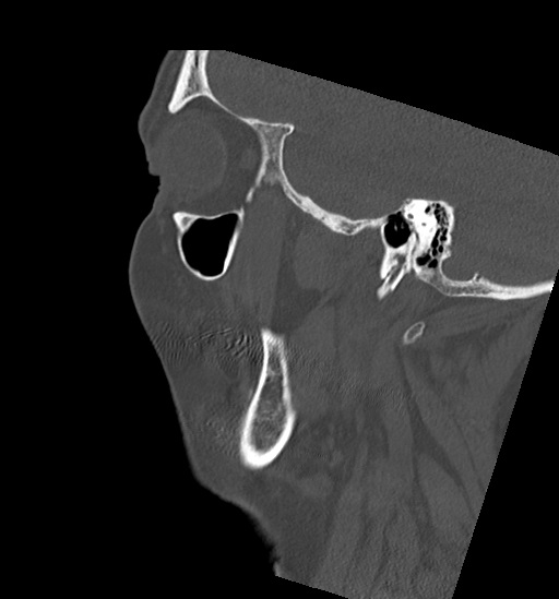 Anterior temporomandibular joint dislocation (Radiopaedia 59430-66784 B 13).jpg