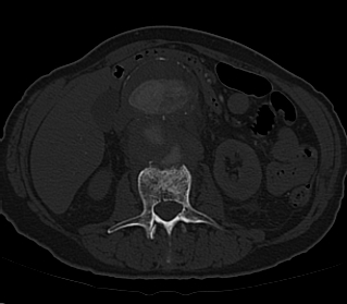 File:Anterior vertebral scalloping (abdominal aortic aneurysm) (Radiopaedia 66744-76067 Axial bone window 5).jpg