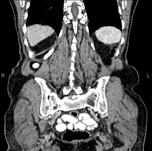 Aortic aneurysm and Lemmel syndrome (Radiopaedia 86499-102554 C 53).jpg
