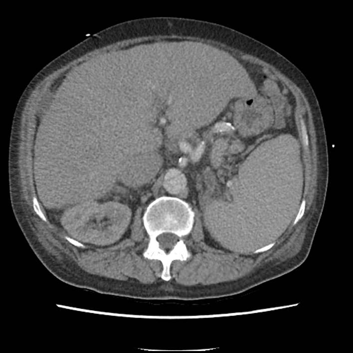 Aortic arch graft infection (FDG PET-CT) (Radiopaedia 71975-82437 A 68).jpg