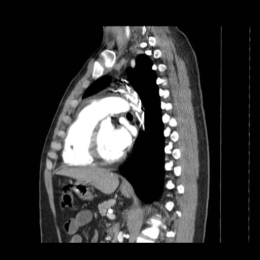 File:Aortic arch stent (Radiopaedia 30030-30595 E 15).jpg