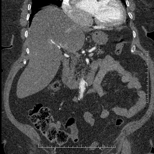 Aortic dissection- Stanford A (Radiopaedia 35729-37268 F 44).jpg