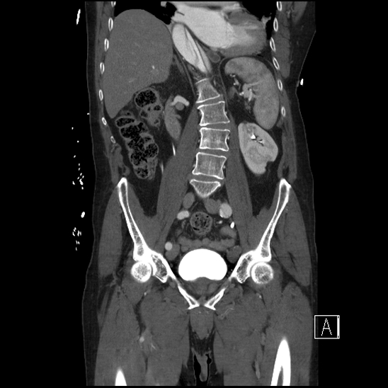 File:Aortic dissection (CTPA) (Radiopaedia 75506-86750 F 39).jpg