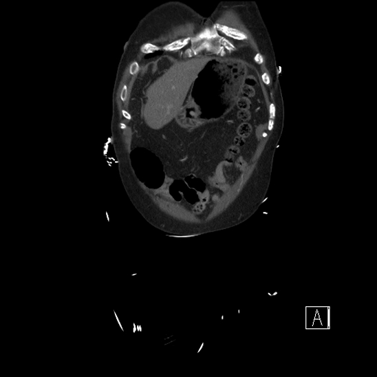 Aortic dissection (CTPA) (Radiopaedia 75506-86750 F 4).jpg