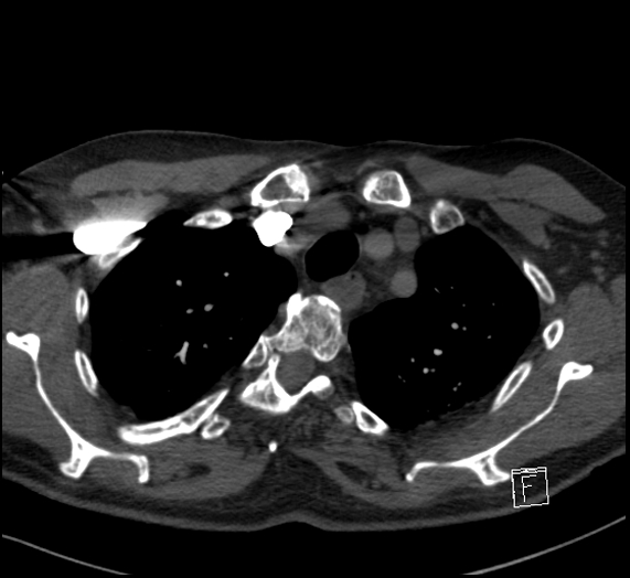 File:Aortic dissection (CTPA) (Radiopaedia 75506-86751 Axial C+ CTPA 27).jpg