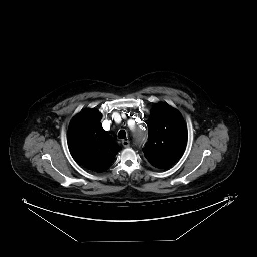 Aortic dissection (Radiopaedia 62562-71000 A 3).jpg