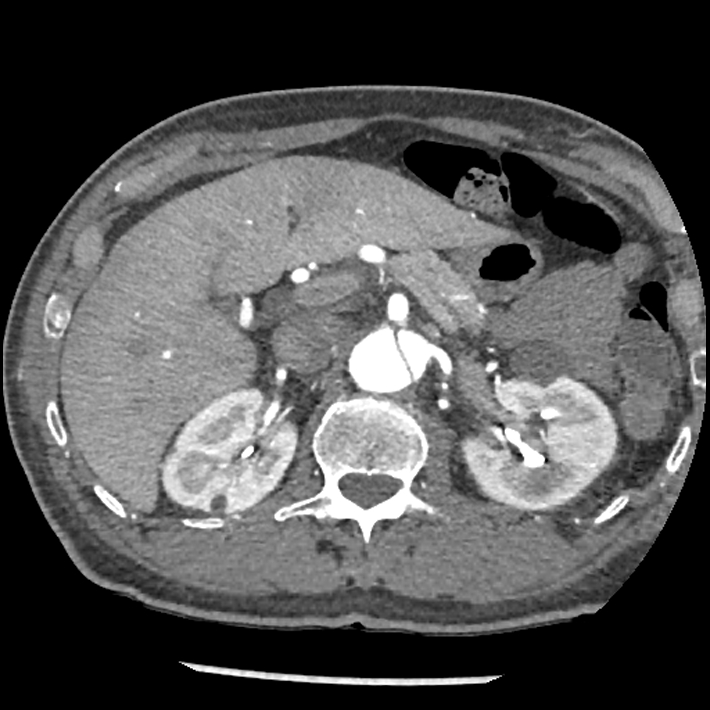 Aortic dissection - DeBakey Type I-Stanford A (Radiopaedia 79863-93115 A 44).jpg