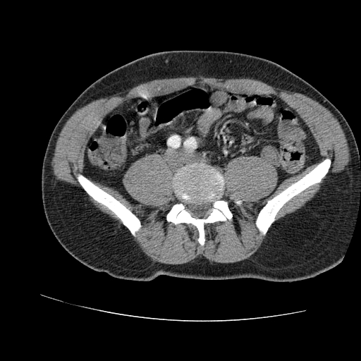 File:Aortic dissection - Stanford A -DeBakey I (Radiopaedia 28339-28587 B 166).jpg