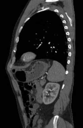 File:Aortic dissection - Stanford type B (Radiopaedia 73648-84437 C 37).jpg