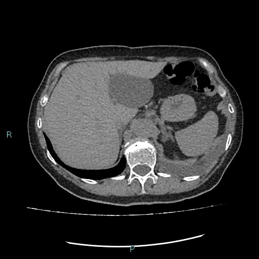 File:Aortic dissection extended to lusory artery (Radiopaedia 43686-47136 Axial non-contrast 28).jpg