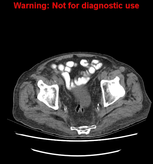 Aortic graft infection (Radiopaedia 44979-48907 Axial non-contrast 83).jpg