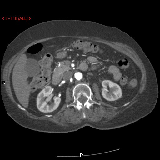 File:Aortic intramural hematoma (Radiopaedia 27746-28001 A 110).jpg