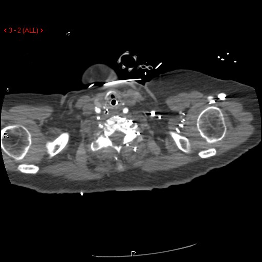 File:Aortic intramural hematoma (Radiopaedia 27746-28001 A 2).jpg
