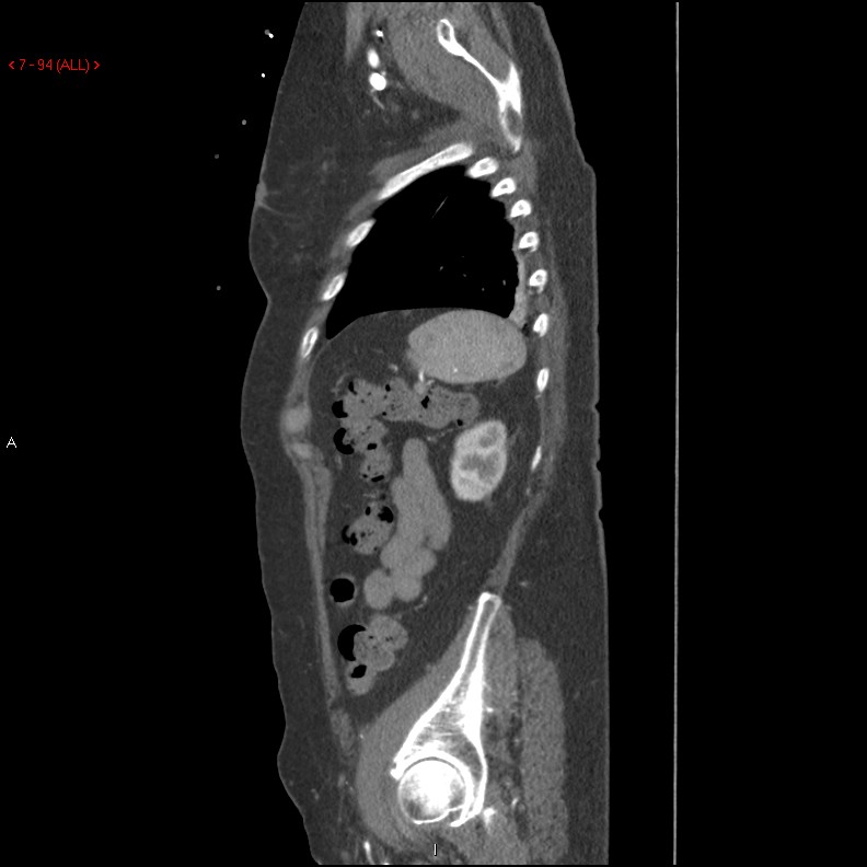 Aortic intramural hematoma (Radiopaedia 27746-28001 C 63).jpg