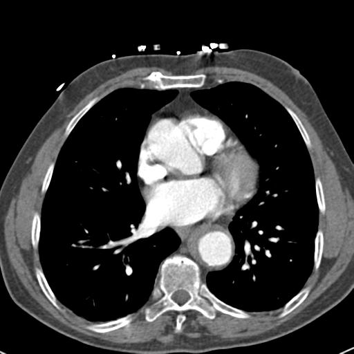 Aortic intramural hematoma (Radiopaedia 31139-31838 B 53).jpg