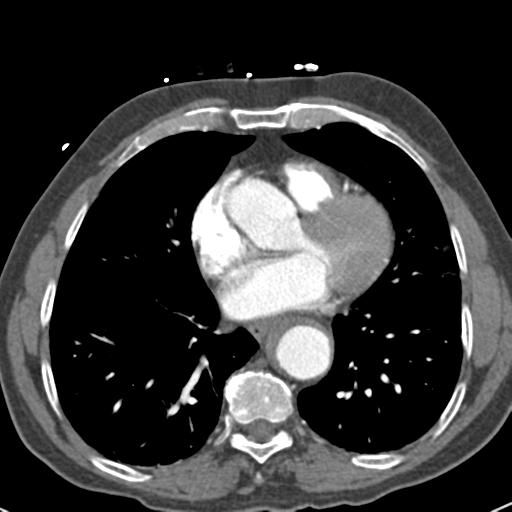 Aortic intramural hematoma (Radiopaedia 31139-31838 B 57).jpg