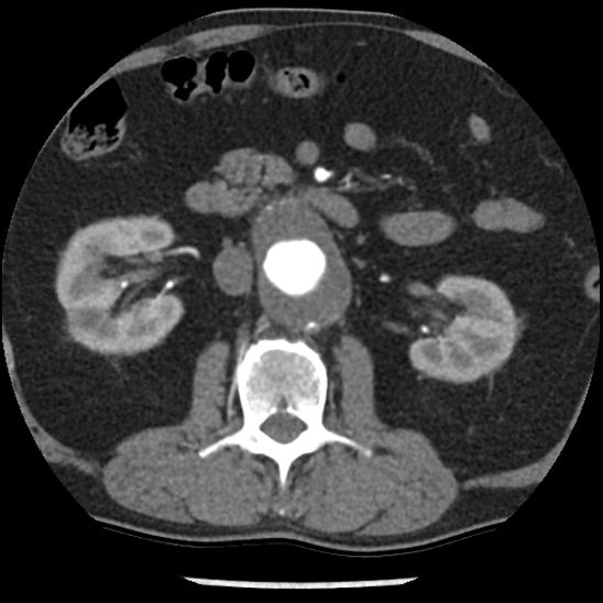 Aortic intramural hematoma (type B) (Radiopaedia 79323-92387 B 69).jpg