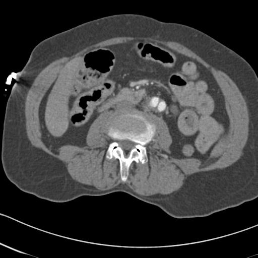Aortic intramural hematoma from penetrating atherosclerotic ulcer (Radiopaedia 31137-31836 A 115).jpg