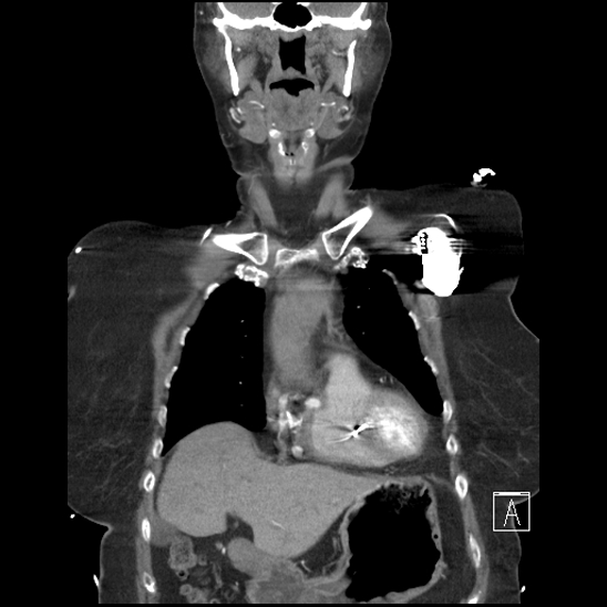 Aortic intramural hematoma with dissection and intramural blood pool (Radiopaedia 77373-89491 C 13).jpg