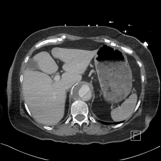 File:Aortic intramural hematoma with dissection and intramural blood pool (Radiopaedia 77373-89491 E 6).jpg