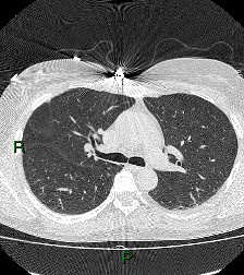 File:Aortic valve endocarditis (Radiopaedia 87209-103485 Axial lung window 42).jpg