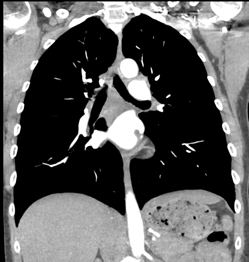 File:Aortic valve non-coronary cusp thrombus (Radiopaedia 55661-62189 C 44).png