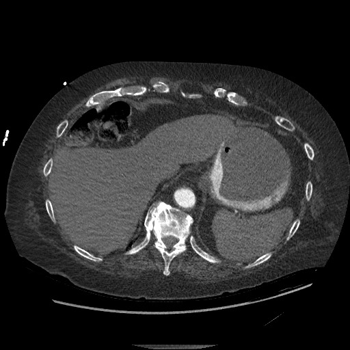 File:Aortoesophageal fistula with endovascular repair (Radiopaedia 73781-84592 Axial C+ CTPA 155).jpg