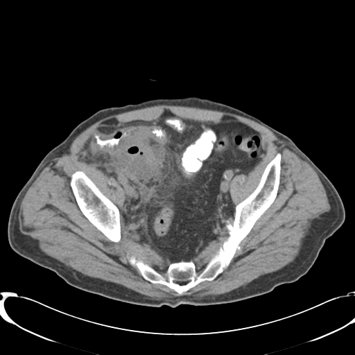 File:Appendiceal abscesses (Radiopaedia 50999-56542 Axial non-contrast 67).png