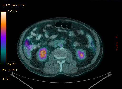 Appendiceal adenocarcinoma complicated by retroperitoneal abscess (Radiopaedia 58007-65041 Axial PET-CT 128).jpg