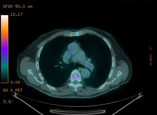 Appendiceal adenocarcinoma complicated by retroperitoneal abscess (Radiopaedia 58007-65041 Axial PET-CT 63).jpg