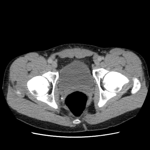 File:Appendicitis complicated by post-operative collection (Radiopaedia 35595-37113 A 75).jpg