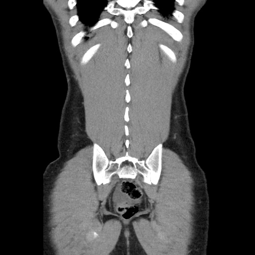 Appendicitis complicated by post-operative collection (Radiopaedia 35595-37114 B 47).jpg