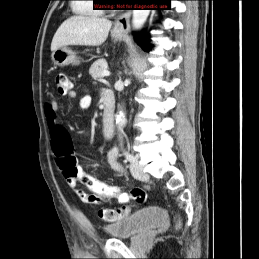 File:Appendicitis mass in inguinal hernia (Radiopaedia 26858-27029 C 31).jpg