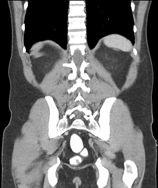 Appendicitis with cecal bar sign (Radiopaedia 31878-32830 A 47).jpg