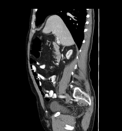Appendicitis with localized perforation and abscess formation (Radiopaedia 49035-54130 C 24).jpg