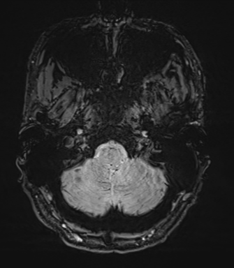 Arachnoid cyst with subdural hematoma (Radiopaedia 85892-101743 Axial SWI 7).png
