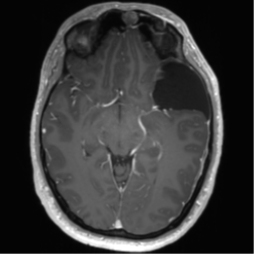Arachnoid cyst with subdural hematoma (Radiopaedia 85892-101743 Axial T1 C+ 40).png