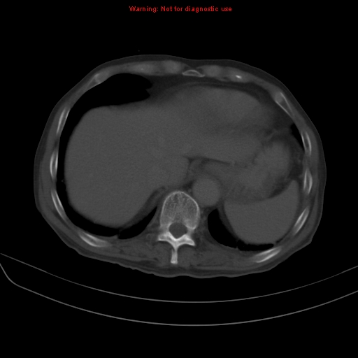 File:Arachnoiditis ossificans (Radiopaedia 51394-57136 Axial bone window 2).jpg
