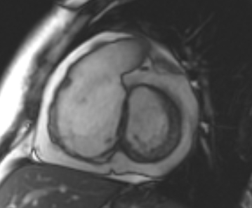 Arrhythmogenic right ventricular cardiomyopathy (Radiopaedia 69431-79307 Short axis cine 176).jpg