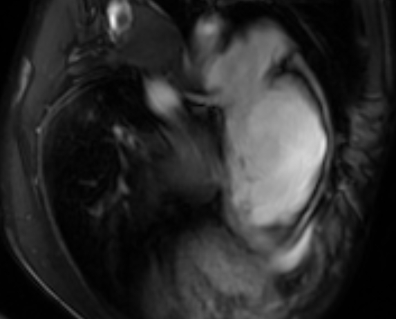 Arrhythmogenic right ventricular cardiomyopathy (Radiopaedia 69564-79464 4ch cine 125).jpg