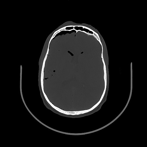 Arrow injury to the brain (Radiopaedia 72101-82607 Axial bone window 73).jpg