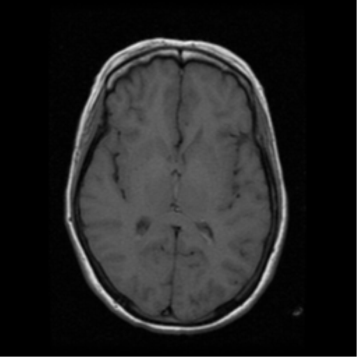 File:Arteriovenous malformation (cerebral) (Radiopaedia 40070-42580 Axial T1 11).png