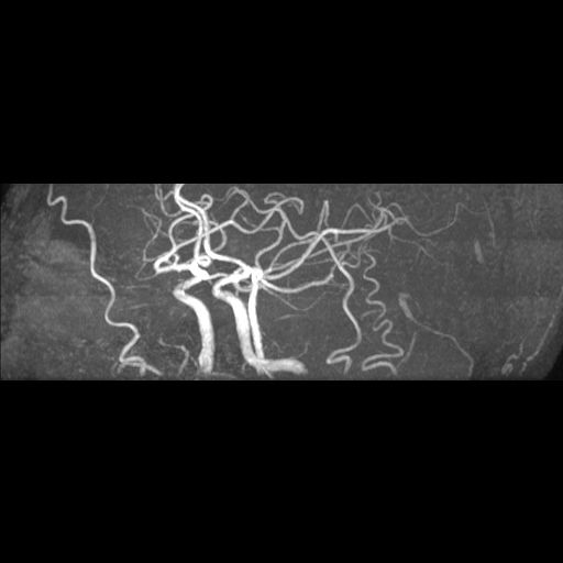Artery of Percheron infarction (Radiopaedia 27975-28230 3D TOF 5).jpg