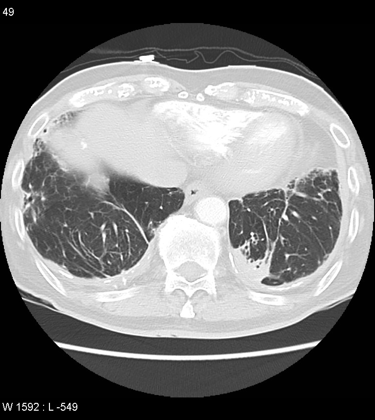 Asbestos related lung and pleural disease (Radiopaedia 14377-14301 A 46).jpg