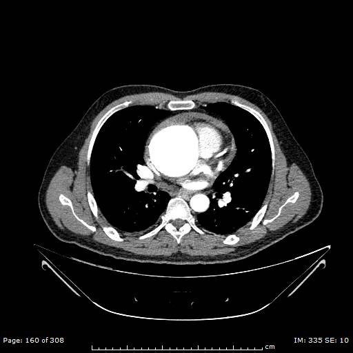Ascending aortic aneurysm (Radiopaedia 50086-55404 A 40).jpg