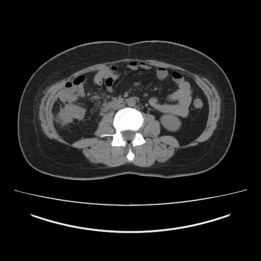 File:Ascending retrocecal appendicitis with liver abscesses (Radiopaedia 60066-67615 Axial non-contrast 46).jpg