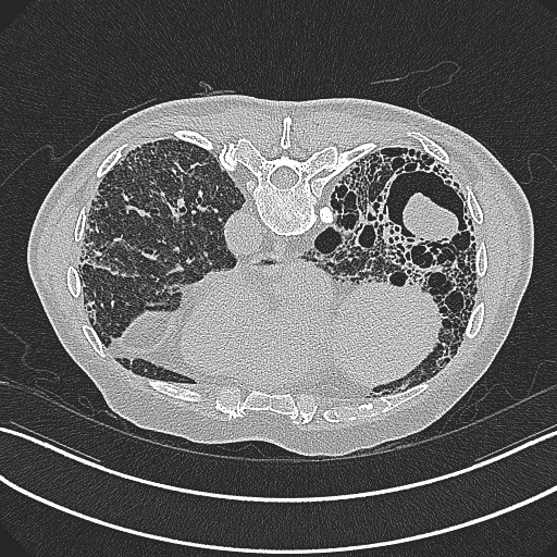 File:Aspergilloma on background pulmonary fibrosis (Radiopaedia 60942-68757 Axial lung window 20).jpg