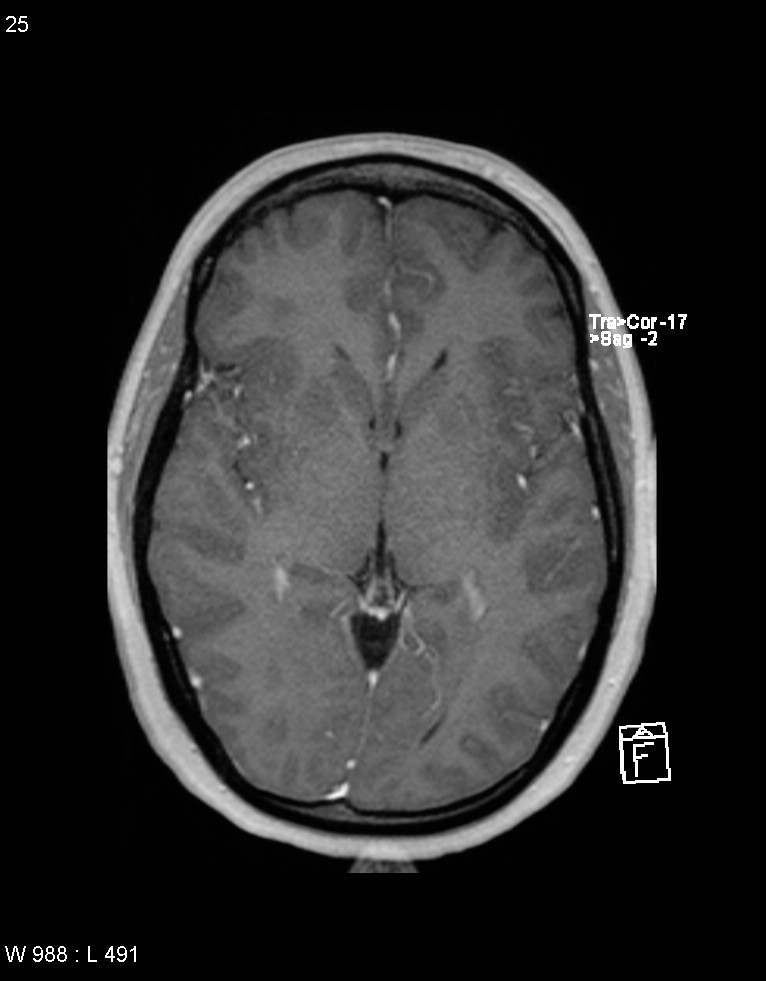 Astroblastoma (Radiopaedia 39792-42217 Axial T1 C+ 24).jpg